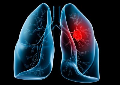 Meet the expert Immunoterapia nel trattamento del carcinoma polmonare metastatico avanzato – Corso FAD 19 Novembre 2021