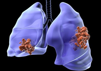 Immunoncologia nel trattamento del carcinoma polmonare. Esperienze di pratica clinica a confronto – Savona (SV) 11 Febbraio 2022