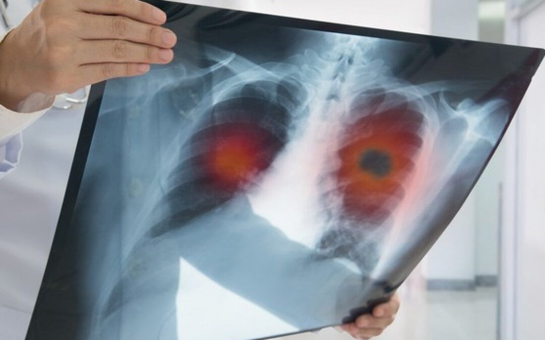 Lung Innovation Aggiornamenti in immunoterapia del polmone – Roma (RM) 25 Ottobre 2022
