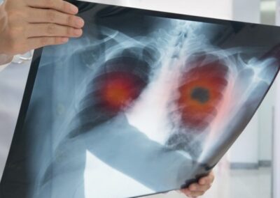 Lung Innovation Aggiornamenti in immunoterapia del polmone – Roma (RM) 25 Ottobre 2022