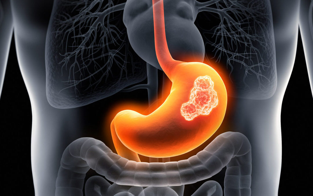 Nuove Frontiere nei tumori gastroesofagei : quali novità? – Catania (CT) 6 Aprile 2024