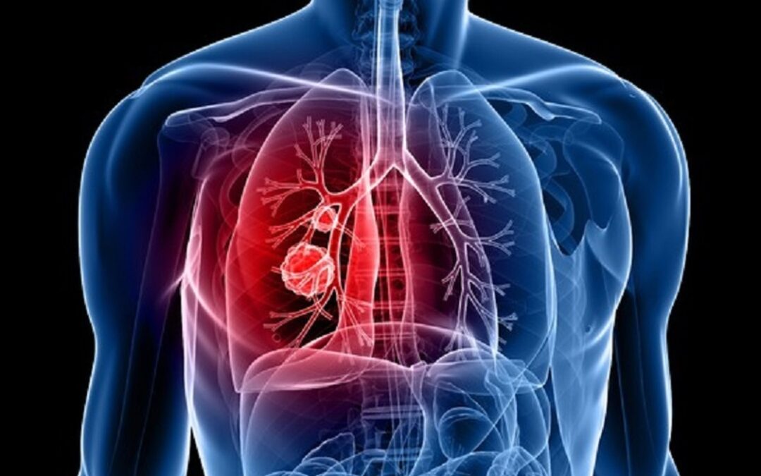 L’esperienza clinica nel trattamento di prima linea NSCLC – Cernusco sul Naviglio (MI) 6 Giugno 2024