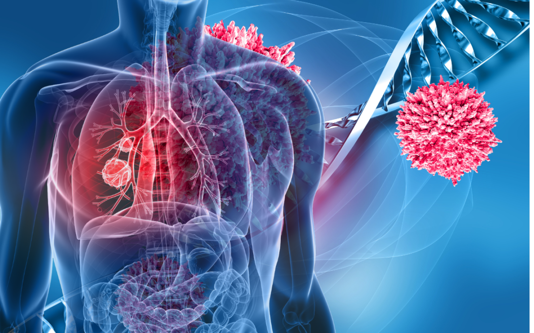 Strategia nel NSCLC avanzato: dalla teoria alla pratica – Milano (MI) 5 Luglio 2024